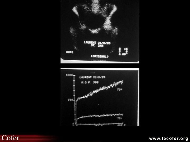 Hyperfixation précoce (au temps vasculaire) et tardive (au temps osseux) en angioscintigraphie. 000000000026s.jpg