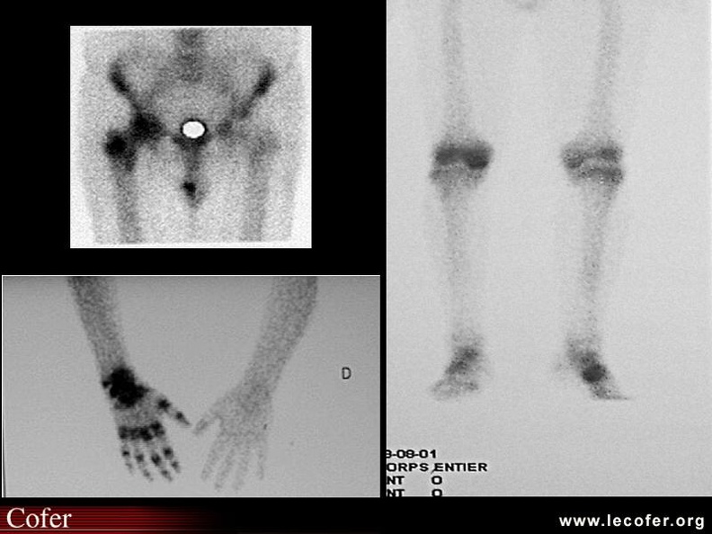 Scintigraphie osseuse : hyperfixation : divers aspects : hanche, main et poignet, genou et cheville. 000000000027s.jpg