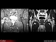 Algoneurodystrophie, algodystrophie de hanche : IRM T1 et fat sat