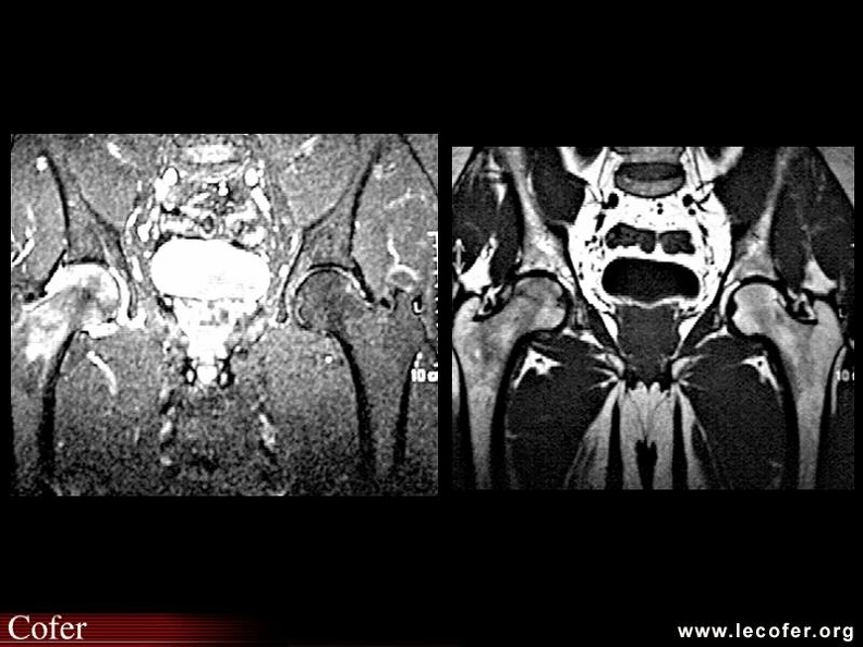 ADSR de hanche : IRM T1 et fat sat : œdème diffus avec hyposignal en T1 et hypersignal en T2 ou fat sat. 000000000033s.jpg