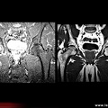 Algoneurodystrophie, algodystrophie de hanche : IRM T1 et fat sat