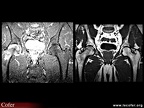 Algoneurodystrophie, algodystrophie de hanche : IRM T1 et fat sat