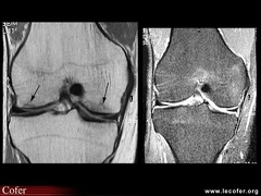 Algoneurodystrophie, algodystrophie : diagnostic différentiel, fractures de fatigue