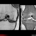 Algoneurodystrophie, algodystrophie : diagnostic différentiel, fractures de fatigue