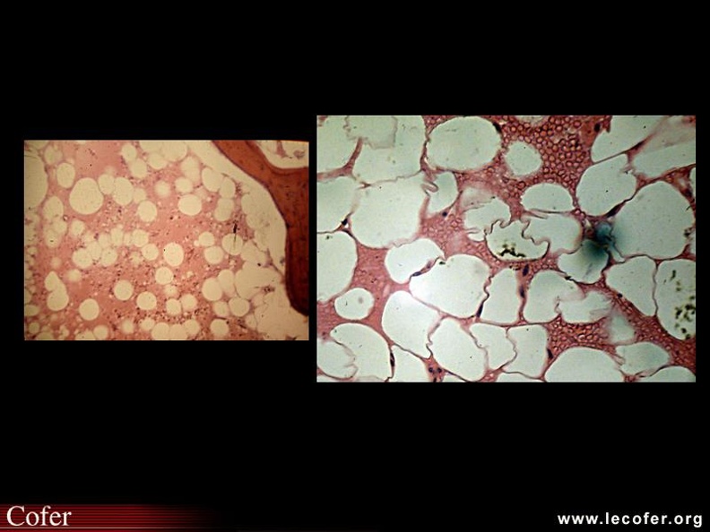 ADSR : anapath. : plasmostase. 000000000035s.jpg