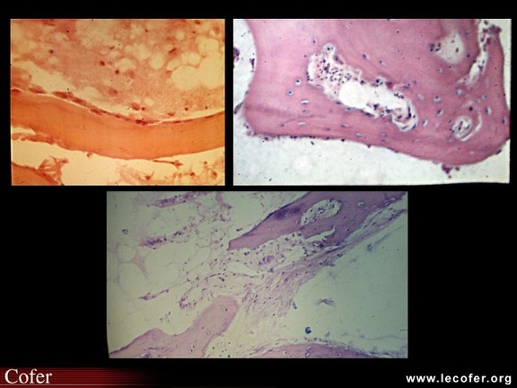 Algoneurodystrophie, algodystrophie : anatomopathologie