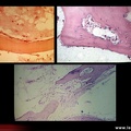 Algoneurodystrophie, algodystrophie : anatomopathologie