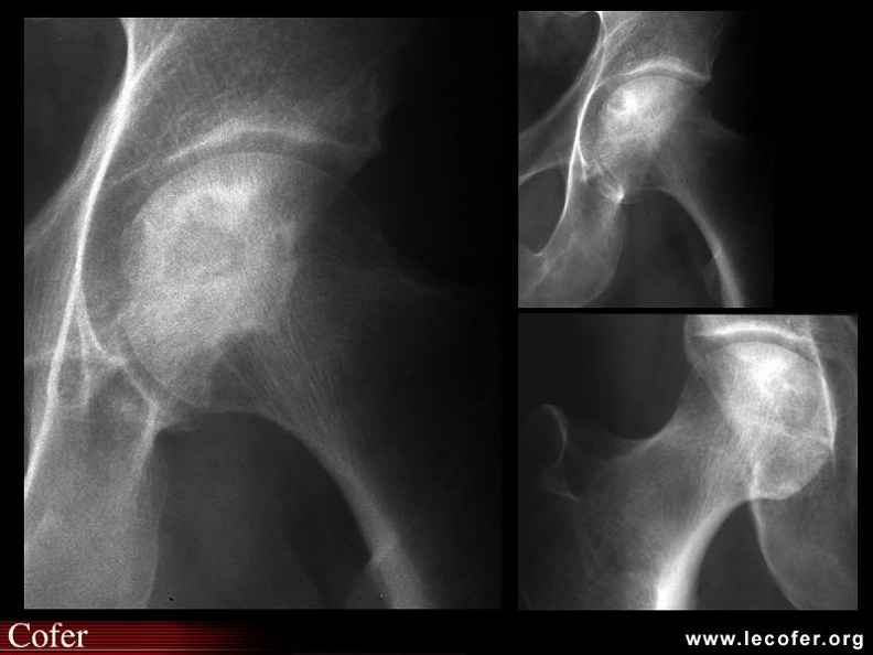 OstéoNécrose Aseptique de Hanche (ONAH) : Radiographies : Stade 2 de la classification d’Arlet et Ficat