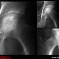 OstéoNécrose Aseptique de Hanche (ONAH) : Radiographies : Stade 2 de la classification d’Arlet et Ficat