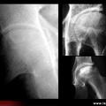OstéoNécrose Aseptique de Hanche (ONAH) : Radiographies : Stade 3 de la classification d’Arlet et Ficat