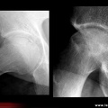 OstéoNécrose Aseptique de Hanche (ONAH) : Radiographies : Stade 3 de la classification d’Arlet et Ficat