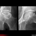 OstéoNécrose Aseptique de Hanche (ONAH) : Radiographies : Stade 3 de la classification d’Arlet et Ficat