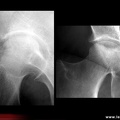 OstéoNécrose Aseptique de Hanche (ONAH) : Radiographies : Stade 3 de la classification d’Arlet et Ficat