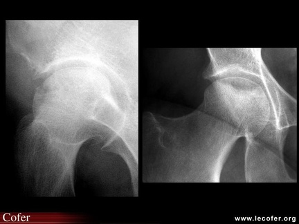 OstéoNécrose Aseptique de Hanche (ONAH) : Radiographies : Stade 3 de la classification d’Arlet et Ficat