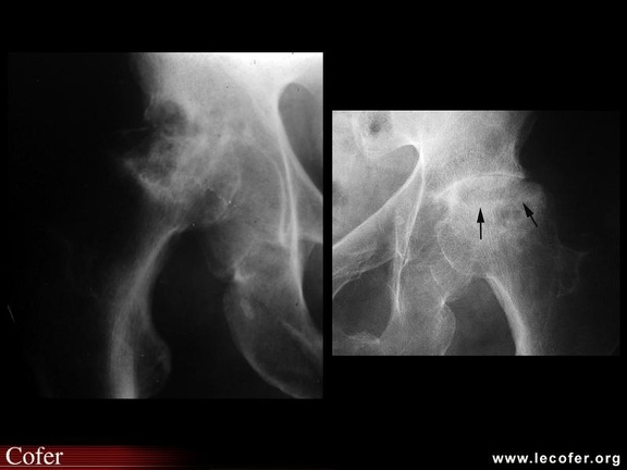 OstéoNécrose Aseptique de Hanche (ONAH) : Radiographies : Stade 4 de la classification d’Arlet et Ficat