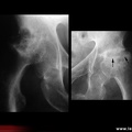 OstéoNécrose Aseptique de Hanche (ONAH) : Radiographies : Stade 4 de la classification d’Arlet et Ficat