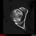 OstéoNécrose Aseptique de Hanche (ONAH) : Tomodensitométrie : Stade II de la classification d’Arlet et Ficat