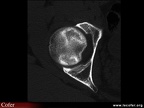 OstéoNécrose Aseptique de Hanche (ONAH) : Tomodensitométrie : Stade II de la classification d’Arlet et Ficat