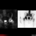 OstéoNécrose Aseptique de Hanche (ONAH) : Scintigraphie osseuse