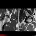 OstéoNécrose Aseptique de Hanche (ONAH) : IRM T1