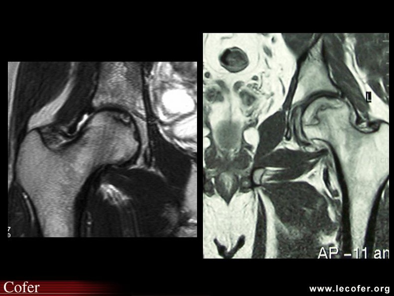 OstéoNécrose Aseptique de Hanche (ONAH) : IRM T2