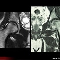 OstéoNécrose Aseptique de Hanche (ONAH) : IRM T2
