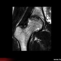 OstéoNécrose Aseptique de Hanche (ONAH) : IRM T2 aspect en « double ring »