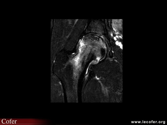 OstéoNécrose Aseptique de Hanche (ONAH) : IRM fat sat