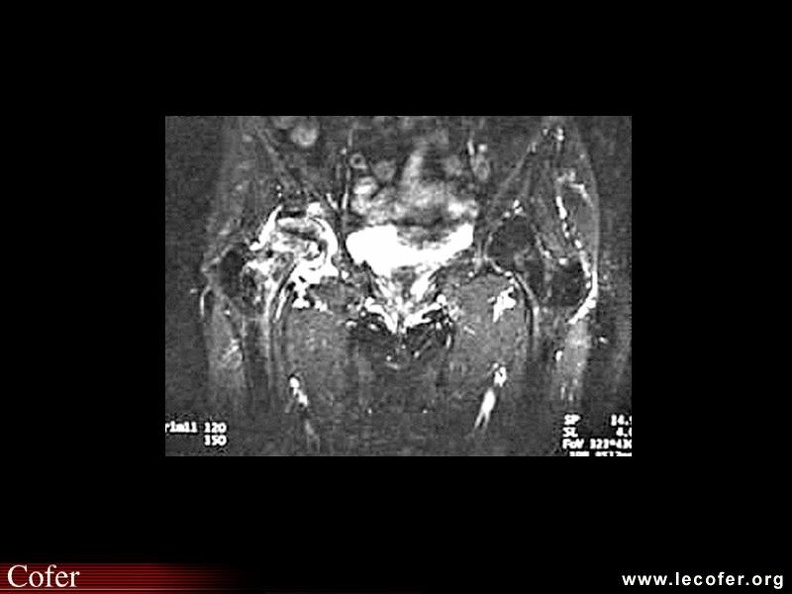 OstéoNécrose Aseptique de Hanche : IRM fat sat