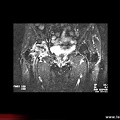 OstéoNécrose Aseptique de Hanche : IRM fat sat