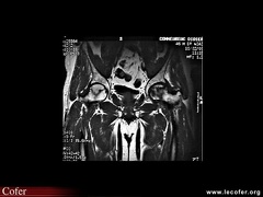 OstéoNécrose Aseptique de Hanche (ONAH) : IRM T1 : ON bilatérale