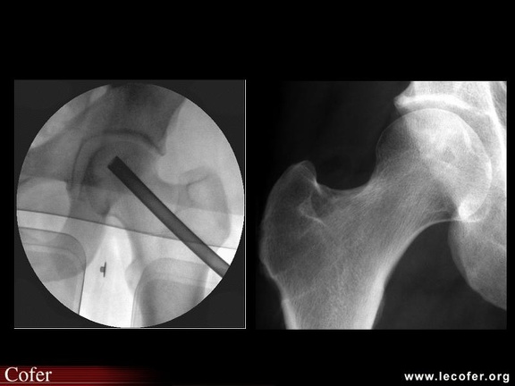 OstéoNécrose Aseptique de Hanche (ONAH) : radiographies pendant et après forage-biopsie