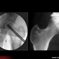 OstéoNécrose Aseptique de Hanche (ONAH) : radiographies pendant et après forage-biopsie