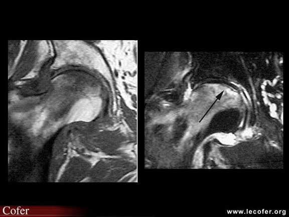 Ostéonécrose aseptique de hanche : diagnostic différentiel : fracture sous-chondrale : aspects IRM