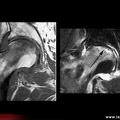 Ostéonécrose aseptique de hanche : diagnostic différentiel : fracture sous-chondrale : aspects IRM