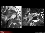 Ostéonécrose aseptique de hanche : diagnostic différentiel : fracture sous-chondrale : aspects IRM