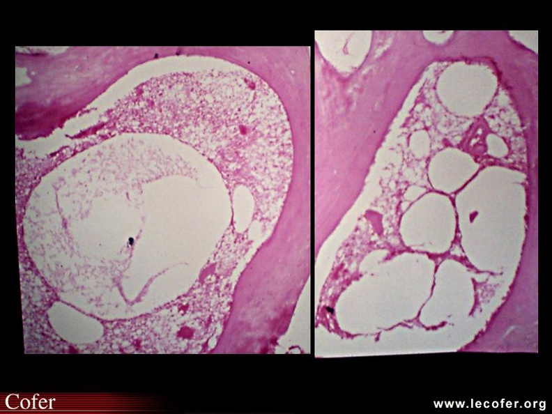 ONAH : anapath. : Dilatation des sinus veineux et nécrose avec balkanisation des adipocytes. 000000000060s.jpg