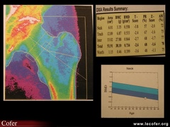 Ostéoporose : mesure de la densité minérale osseuse du fémur