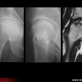 Ostéonécrose de hanche : aspects radiologiques et IRM