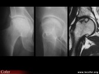Ostéonécrose de hanche : aspects radiologiques et IRM