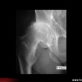 Coxarthrose : pincement supérieur