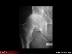 Coxarthrose : pincement supérieur