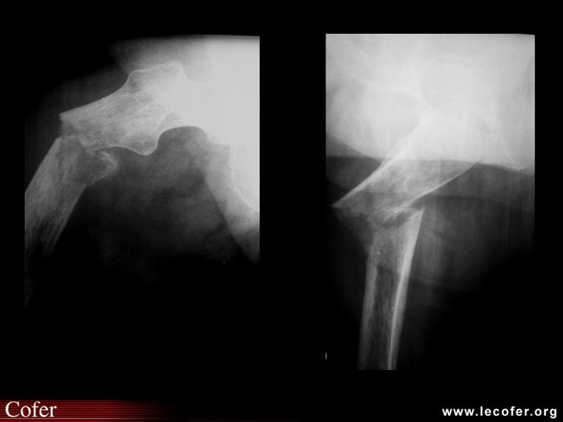 Fracture du fémur pathologique