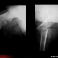 Fracture du fémur pathologique