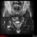 Polyarthrite rhumatoïde : anomalies de la hanche droite (polyarthrite rhumatoïde)