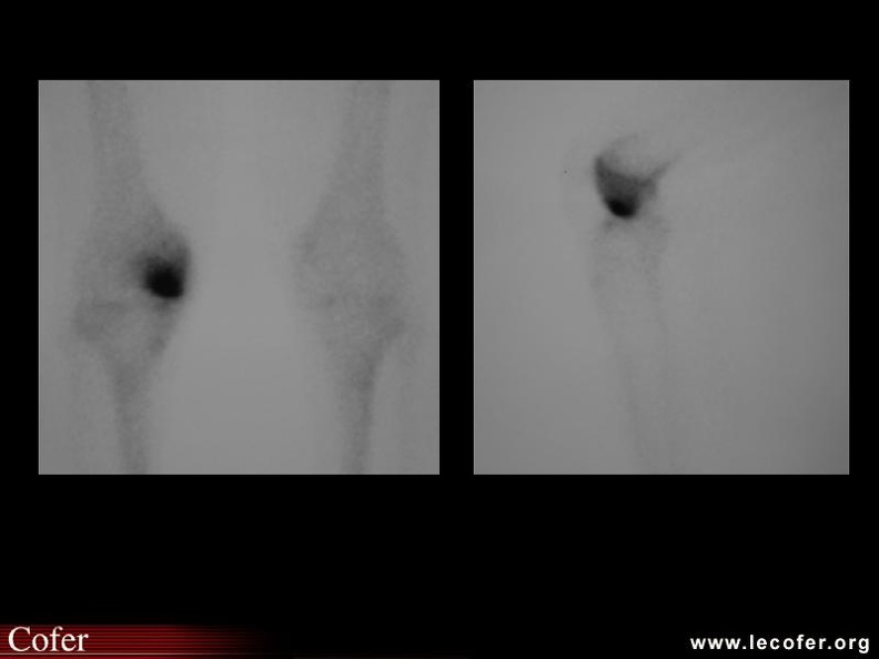 Scintigraphie osseuse. 000000000390.jpg