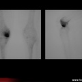 Ostéonécrose du genou droit