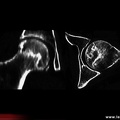 Ostéonécrose de la tête fémorale (scanner)