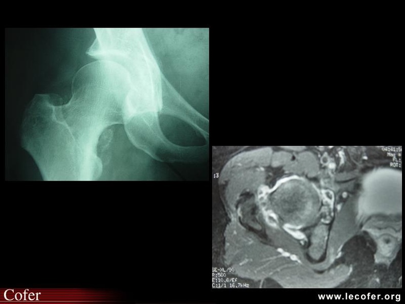 Chondromatose. 000000000456s.jpg
