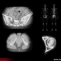 Scintigraphie osseuse-scanner : triple fracture sacrum, cotyle, ischion gauches